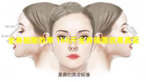 全身抽脂效果 160斤全身抽脂效果真实